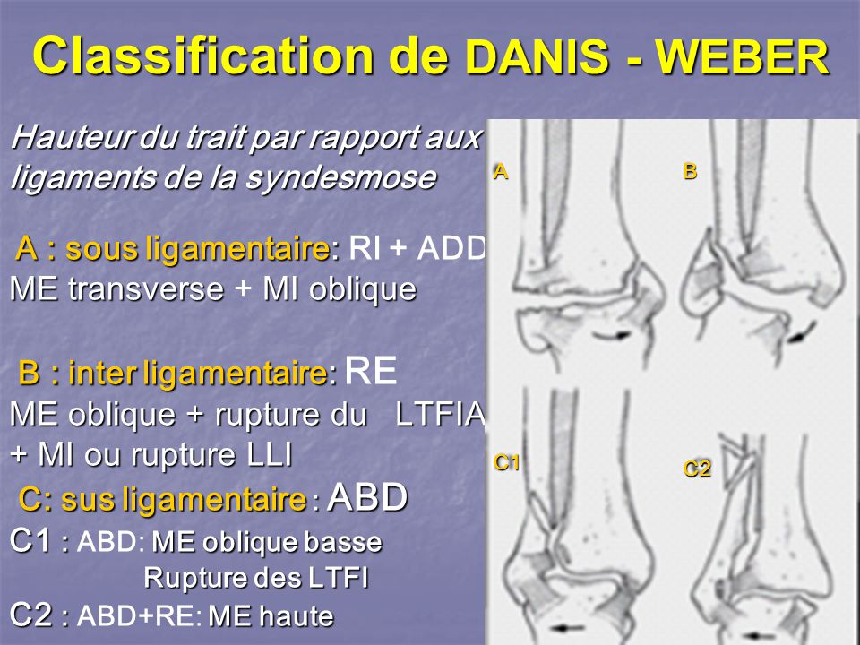 LES FRACTURES MALLEOLAIRES ppt video online t l charger